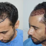 Hair Transplant in Dubai: How to Select the Best Clinic for Your Needs