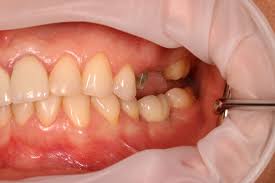 Improving Your Life Quality with Danties Protezas