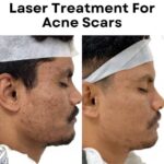 What to Expect During and After Laser Scar Removal Treatment